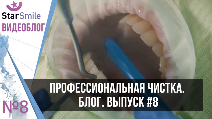 Профессиональная чистка зубов при интраоральном сканировании. Выпуск #8